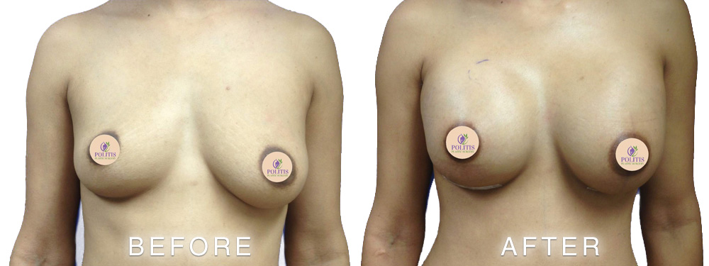 Breast Augmentation - Before & After 2 photo