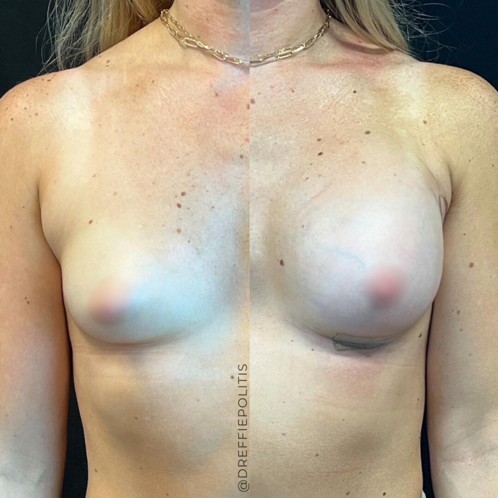 Breast Augmentation: Before and After 1