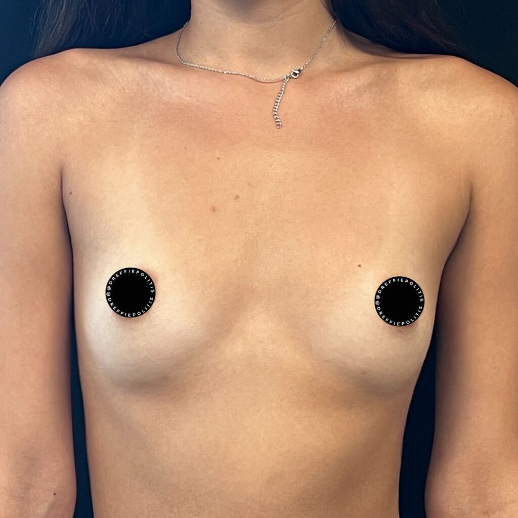 primary breast augmentation gallery