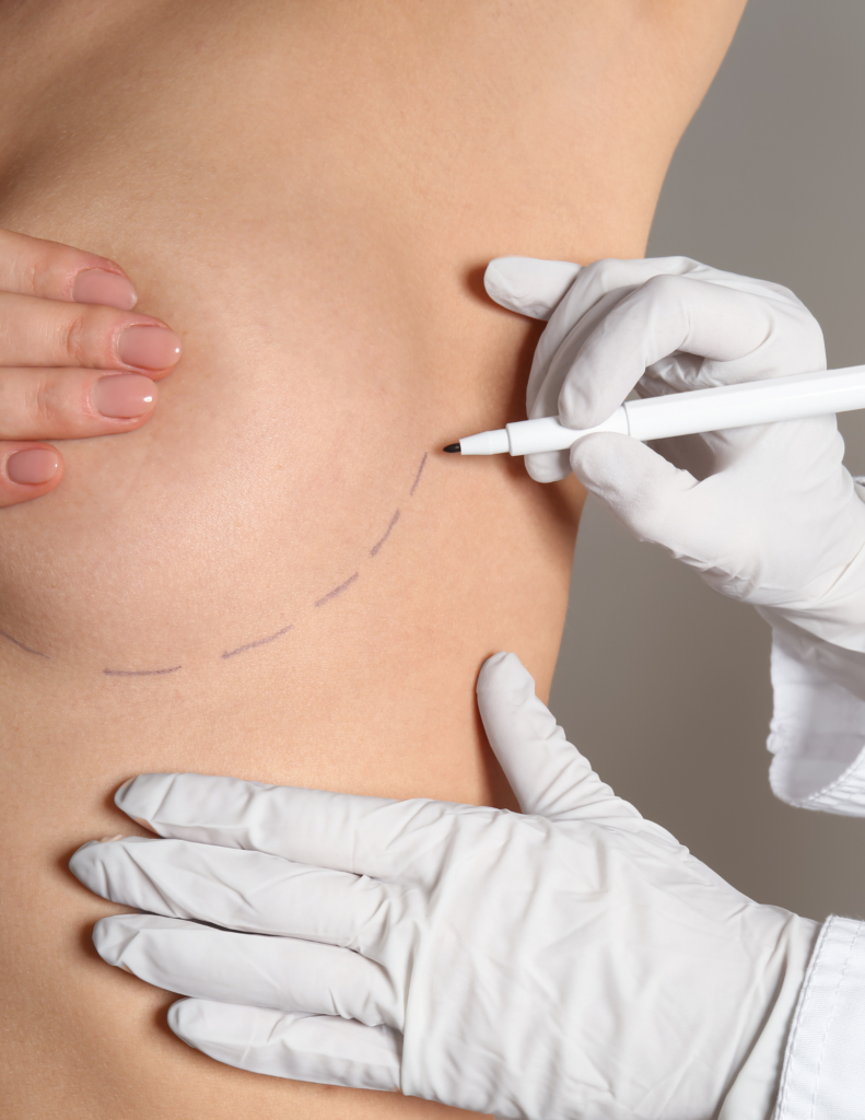 A doctor making surgical markings on her breast augmentation patient.