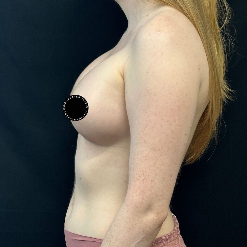 primary breast augmentation gallery